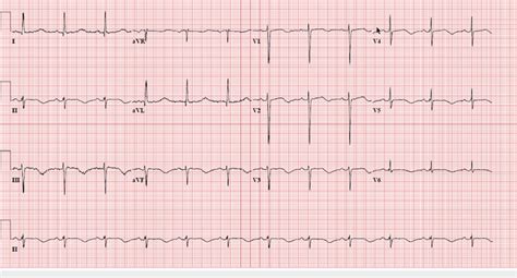 minimal voltage for lvh